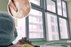 做308激光不紅正常嗎會(huì)留疤嗎